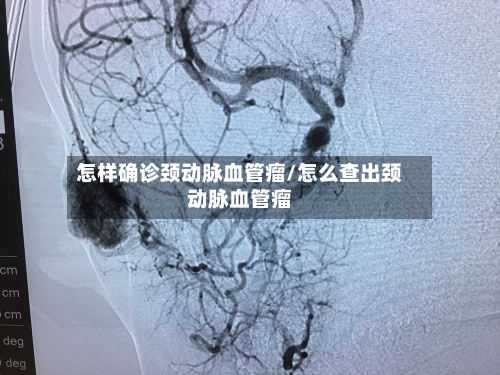 怎样确诊颈动脉血管瘤/怎么查出颈动脉血管瘤