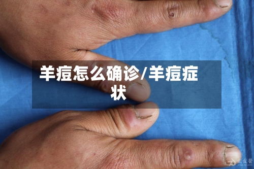 羊痘怎么确诊/羊痘症状-第3张图片