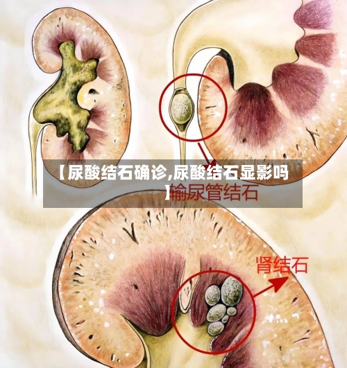 【尿酸结石确诊,尿酸结石显影吗】
