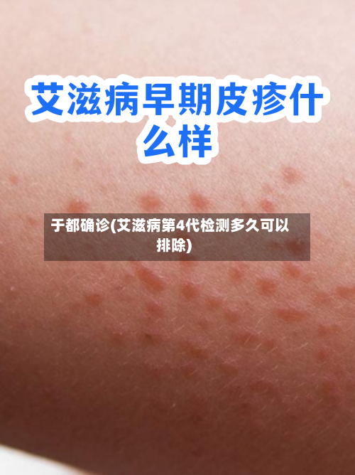 于都确诊(艾滋病第4代检测多久可以排除)-第2张图片