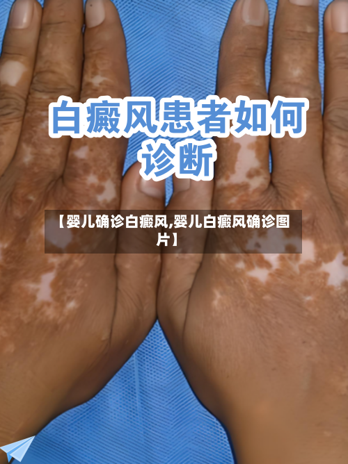 【婴儿确诊白癜风,婴儿白癜风确诊图片】-第2张图片