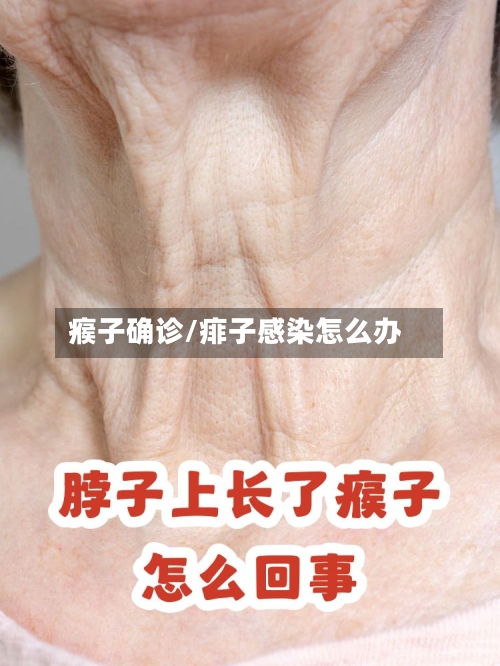 瘊子确诊/痱子感染怎么办