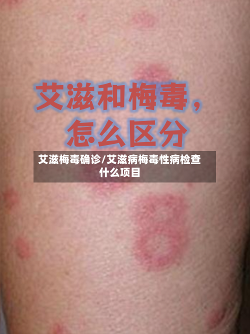 艾滋梅毒确诊/艾滋病梅毒性病检查什么项目-第3张图片
