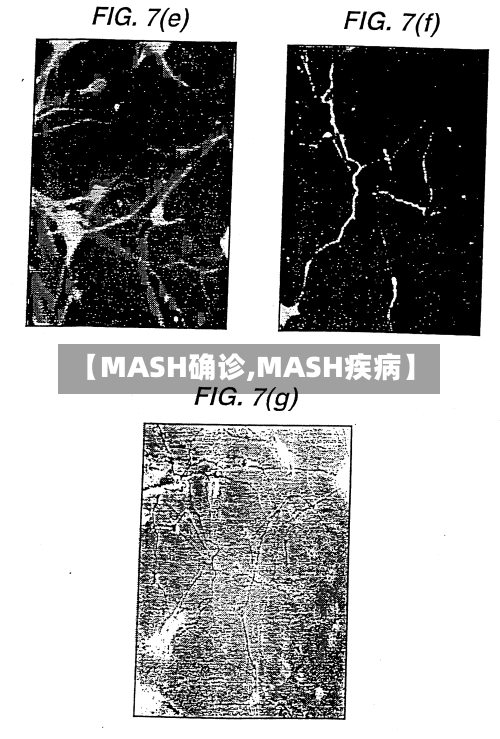 【MASH确诊,MASH疾病】-第2张图片